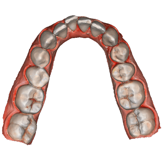 کراودینگ های دندانی مایلد - لابراتوار اتیوس