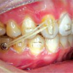 Techniques for Class II Correction with Invisalign and Elastics